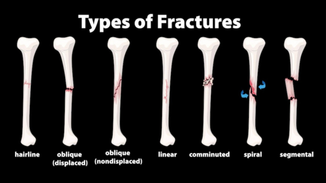 2-dari-5-orang-indonesia-berisiko-osteoporosis-ini-nutrisi-dan-gaya-hidup-yang-harus-diperhatikan_194287f.jpg