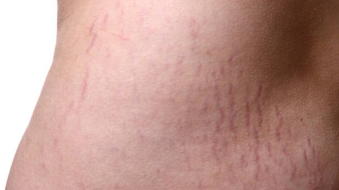 benarkah-stretch-mark-bisa-dihilangkan-dengan-bahan-alami_72bbf17.jpg