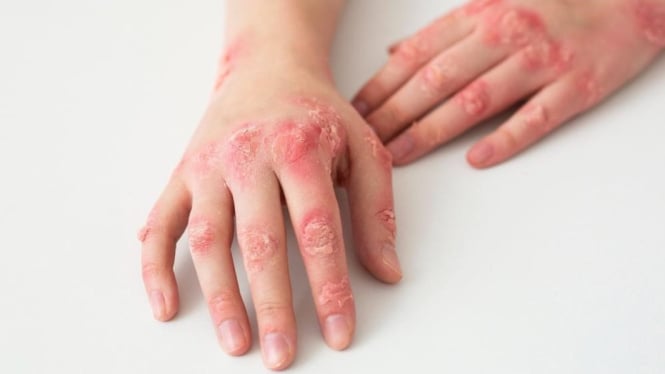 kenali-jenis-jenis-psoriasis-genital-penyebab-kewanitaan-gatal_a3f78d1.jpg