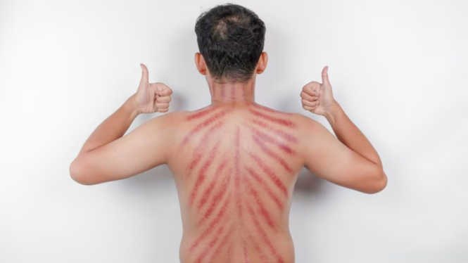 bukan-dikerok-begini-penanganan-tepat-ketika-badan-greges-masuk-angin_c6323d4.jpg