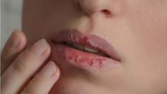 cara-sederhana-merawat-bibir-agar-tetap-lembut-dan-tidak-pecah-pecah_77cc522.jpg