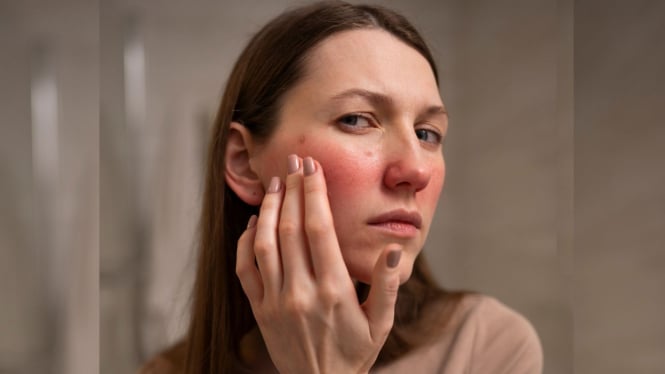lagi-tren-treatment-laser-vbeam-atasi-berbagai-kemerahan-pada-kulit-termasuk-rosacea_5db6180.jpg