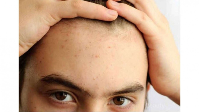 mengenal-perbedaan-fungal-acne-dan-bruntusan-penyebab-gejala-dan-cara-mengatasinya_9f05d63.jpg