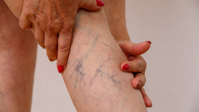varises-bisa-sebabkan-pembengkakan-hingga-kram-kaki-dokter-ungkap-cara-efektif-menghilangkannya_19a993d.jpg